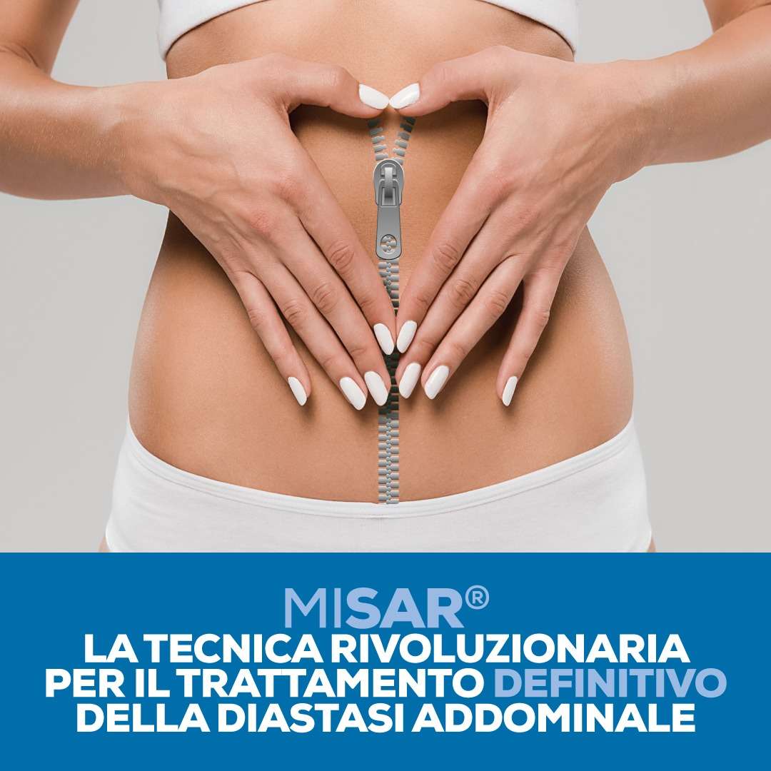 MISAR trattamento definitivo diastasi addominale a Siracusa Villa Rizzo: La Nuova Frontiera della Chirurgia Mininvasiva