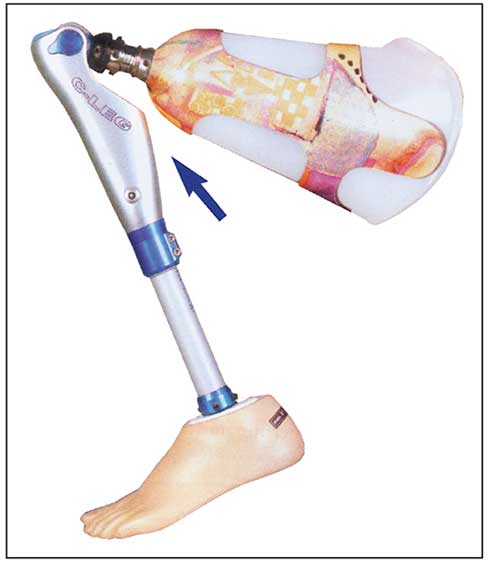 Ortopedia Meridionale Zungri Srl: ginocchio modulare C-LEG