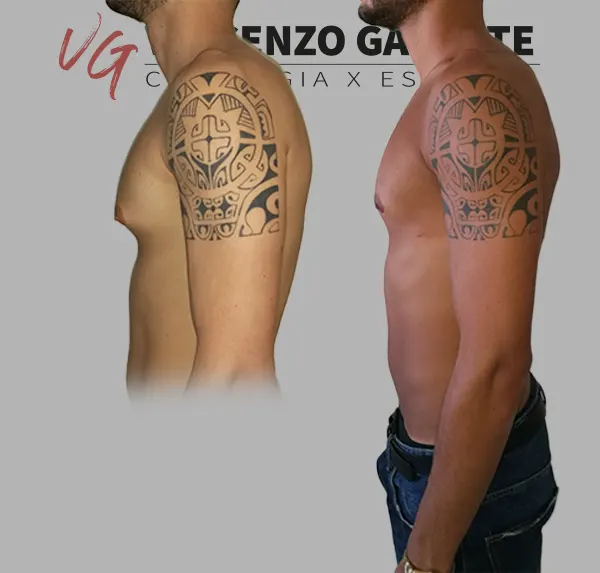 Ginecomastia a Roma Dot. Vincenzo Galante: guida completa all’intervento e al recupero